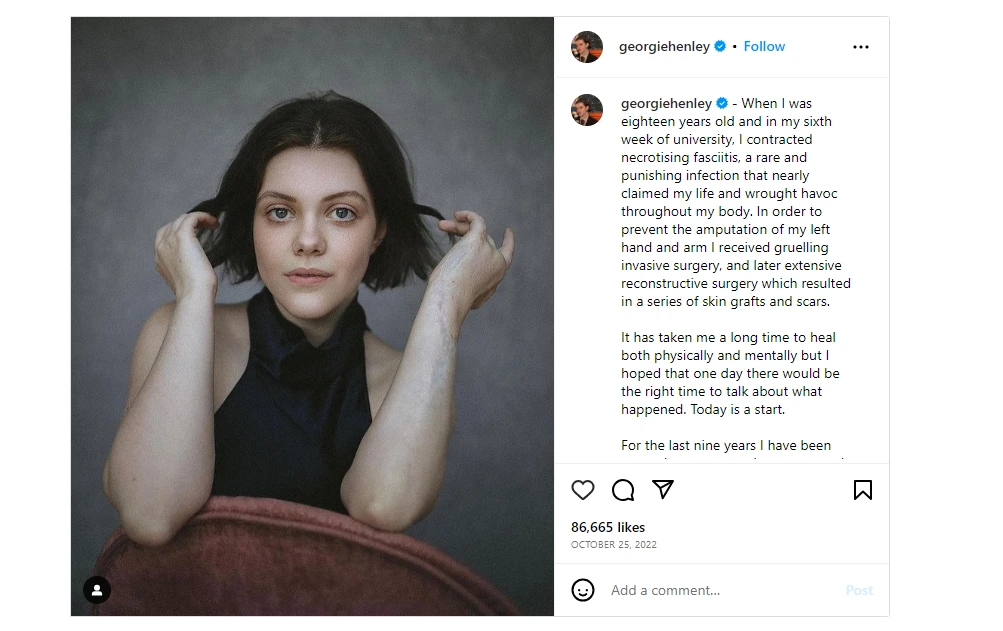 Georgie-Henley-shared-her-experience-after-going-through-flesh-eating-disease